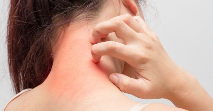 Dấu hiệu ngứa khắp người càng gãi càng ngứa bệnh gì