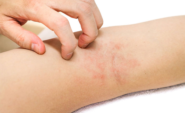 Cách giảm ngứa khắp người càng gãi càng ngứa
