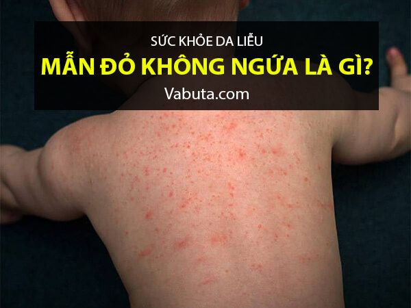 Nổi mẩn đỏ khắp người không sốt không ngứa