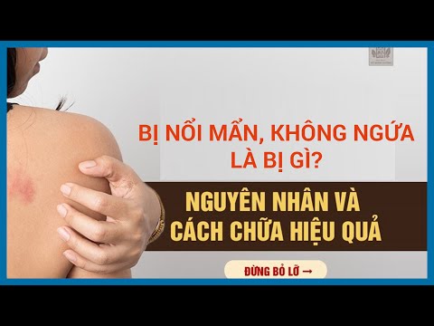 U máu nổi mẩn đỏ khắp người không sốt