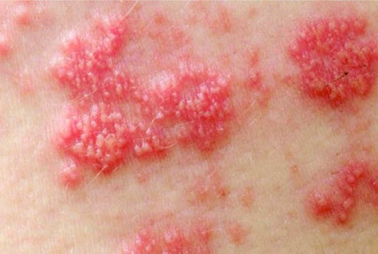 da mẫn đỏ nổi mủ không ngứa