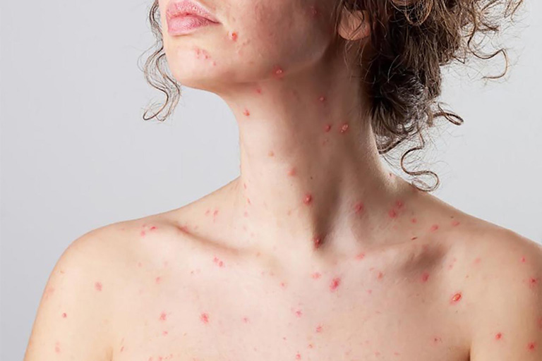 iều trị tình trạng da nổi đỏ ửng có mủ