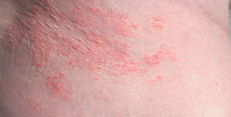 nổi mẩn đỏ ngứa ở háng