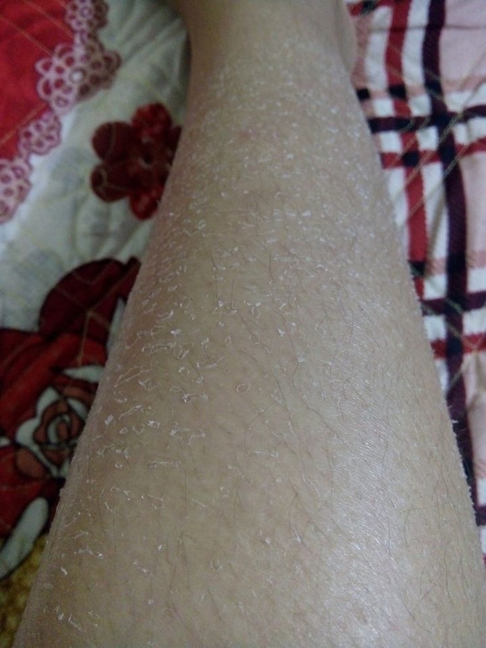 da chân bị khô bong tróc vảy trắng