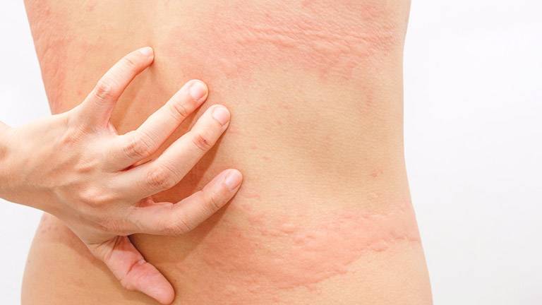 nổi mẩn ngứa thành mảng