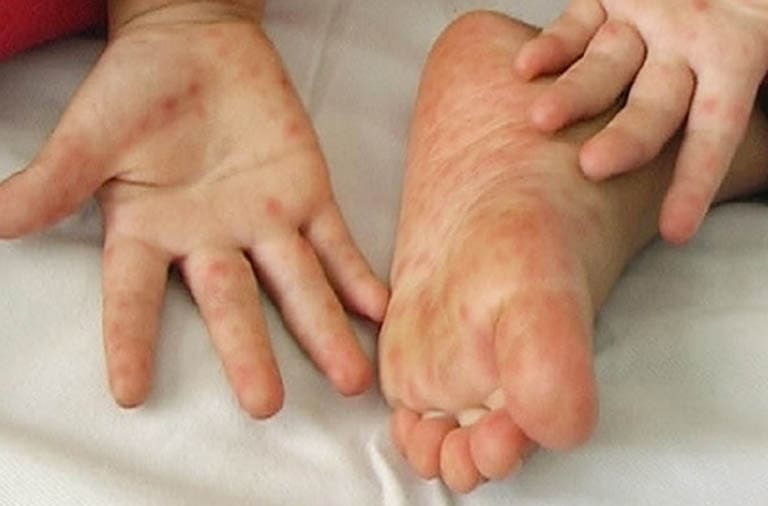 trẻ bị nổi mụn nước ở lòng bàn chân