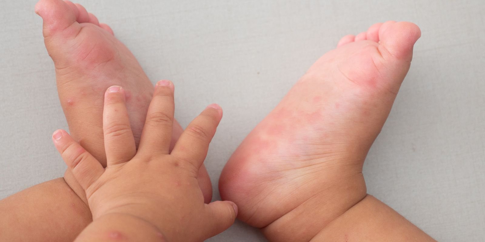 bé bị nổi mụn nước ở lòng bàn chân?