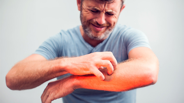 Bị Ngứa râm ran dưới da là căn bệnh gì
