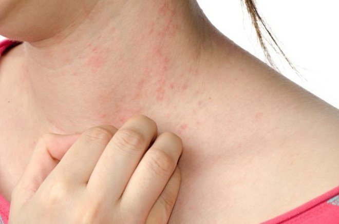 Ngứa da vào mùa đông lạnh dấu hiệu bệnh gì