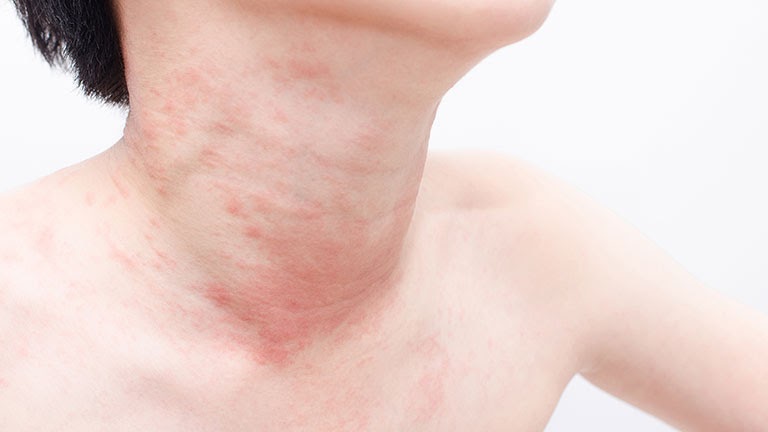 Bị mẩn ngứa ngáy ở cổ là căn bệnh gì