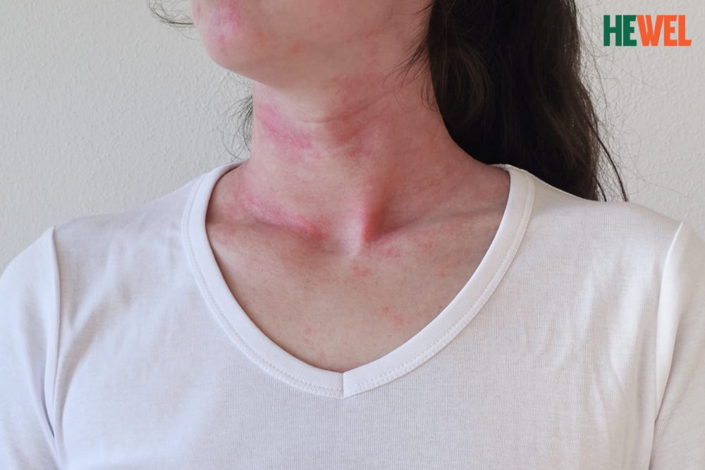 Chẩn đoán nổi mẩn đỏ ngứa ngáy khó chịu ở cổ
