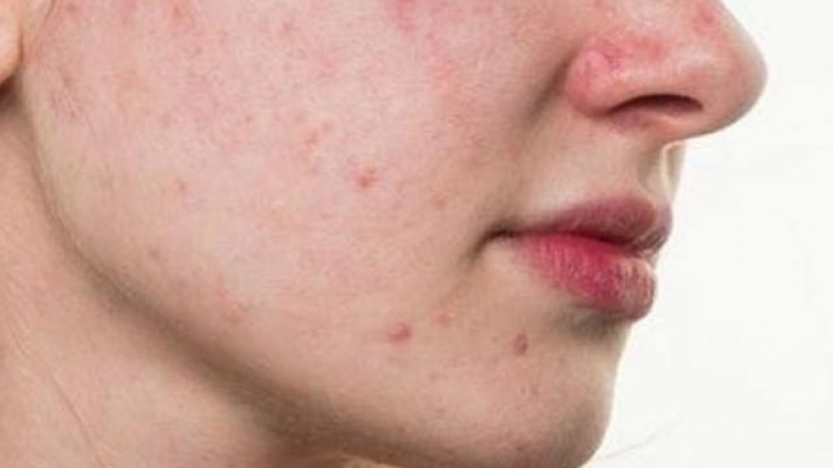 Da mặt ngứa và sần sùi lưu ý bệnh gì?