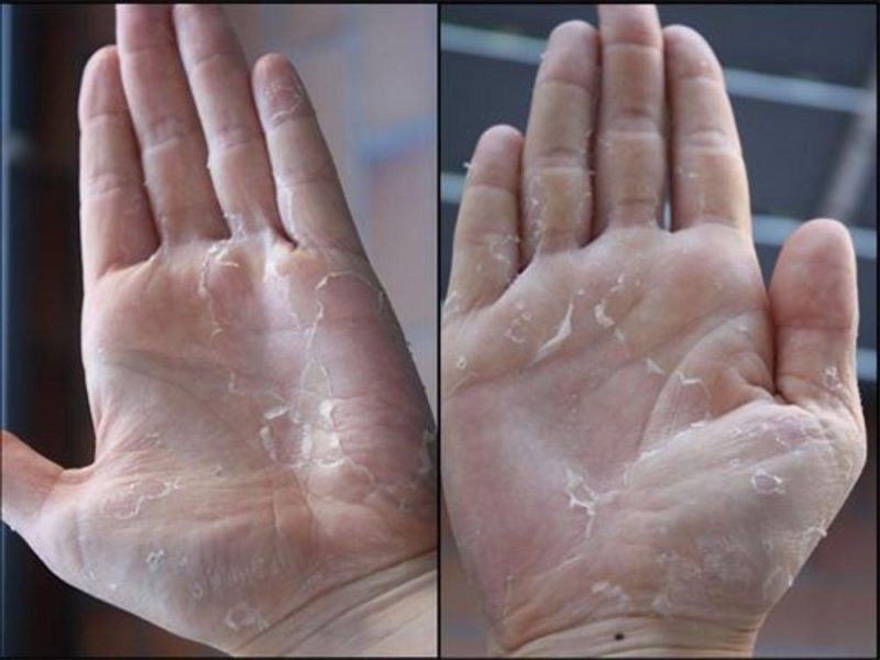 lột da tay xong bị ngứa