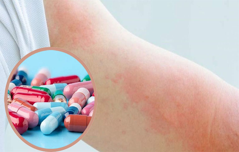 nổi mẩn đỏ ngứa ngáy khó chịu ở bụng bằng thuốc Tây