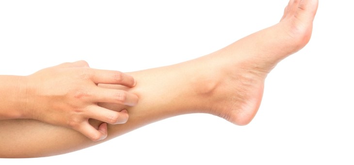 Ngứa hai ống chân do dị ứng
