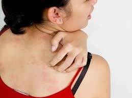Ngứa khắp người sau khi tắm có khả năng do tắm nước cứng