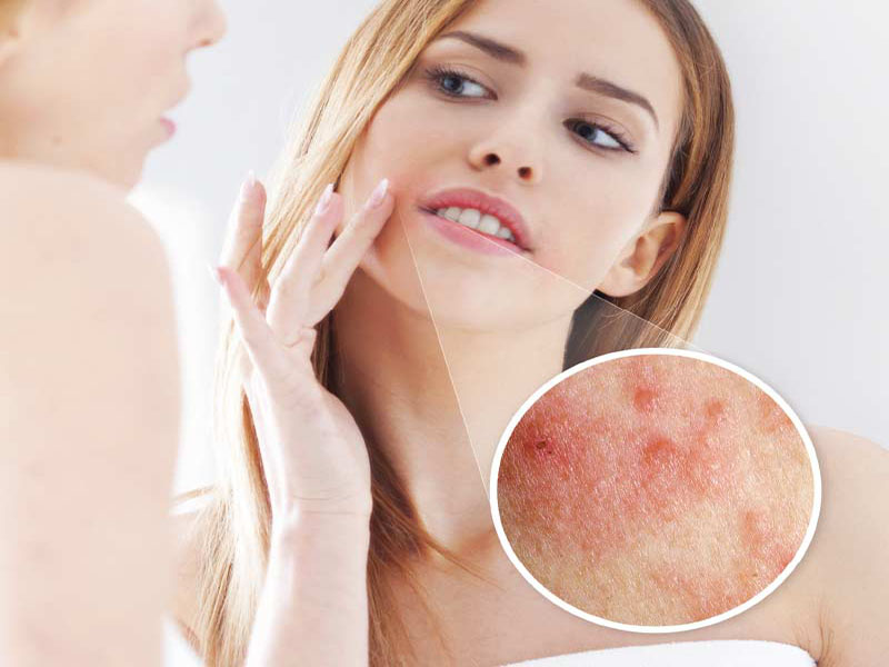 bệnh chàm môi dẫn tới tình trạng ngứa quanh miệng