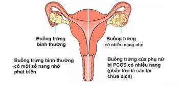 buồng trứng có nhiều nang nhỏ