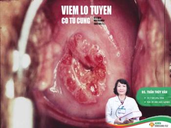 hinh anh viem lo tuyen co tu cung