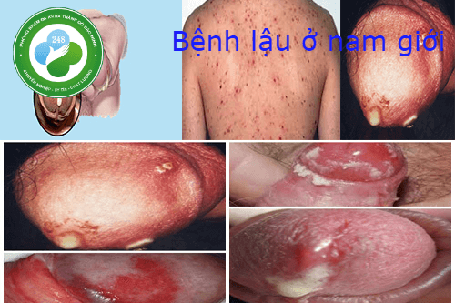 Bệnh lậu ở Nam giới