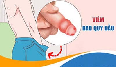 viêm bao quy đầu
