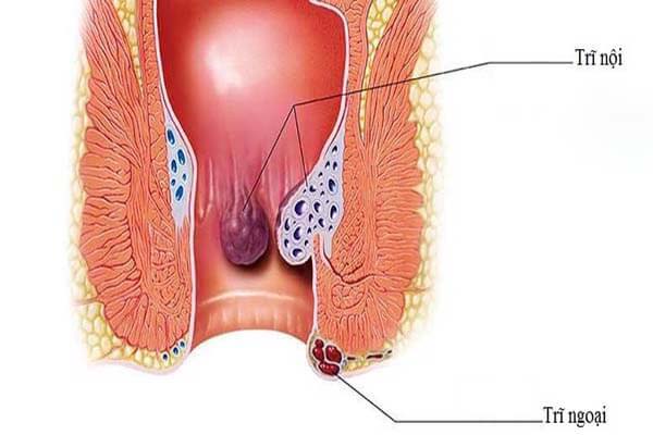 triệu chứng trĩ nội