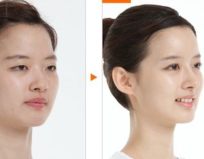 Nâng mũi bằng sụn tự thân giá bao nhiêu