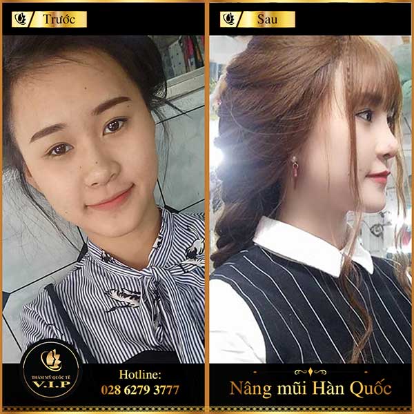 Nâng mũi Hàn Quốc ở đâu đẹp