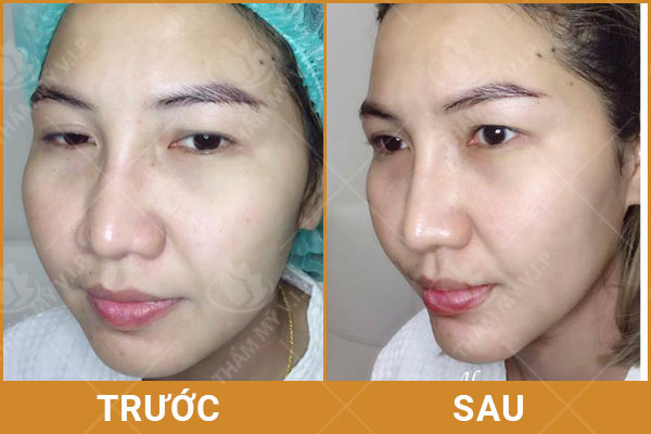 nâng mũi tiêm filler có sưng mấy ngày