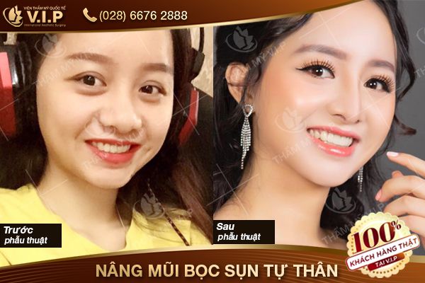 Khách hàng sửa mũi bọc sụn tự thân