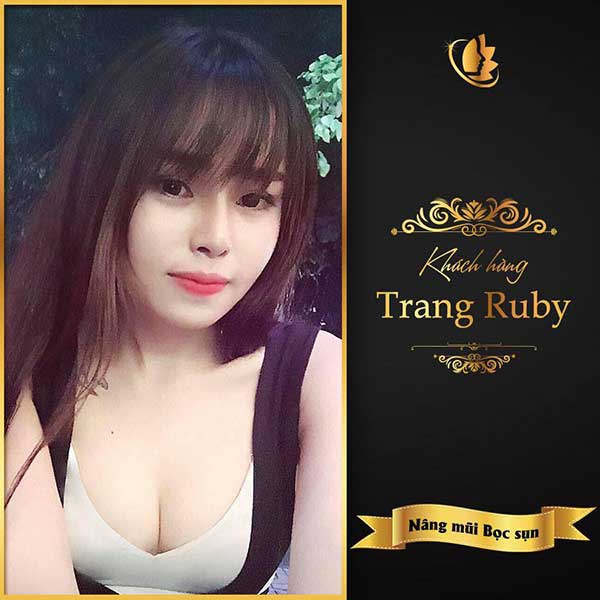 Nâng mũi bằng sụn tai có nên không