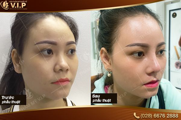 Chi phí nâng mũi bọc sụn megaderm bao nhiêu tiền