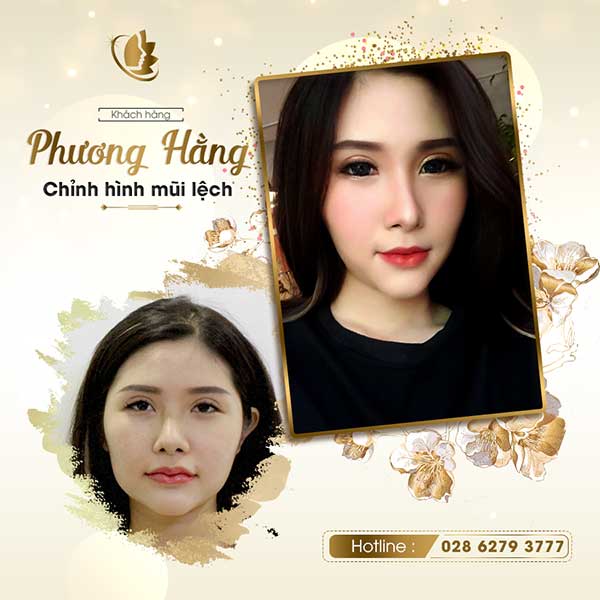 chỉnh sửa mũi hòng