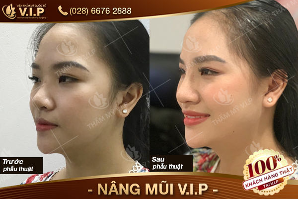 chườm đá sau khi nâng mũi