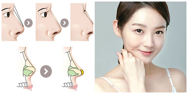 nâng mũi ở đâu đẹp