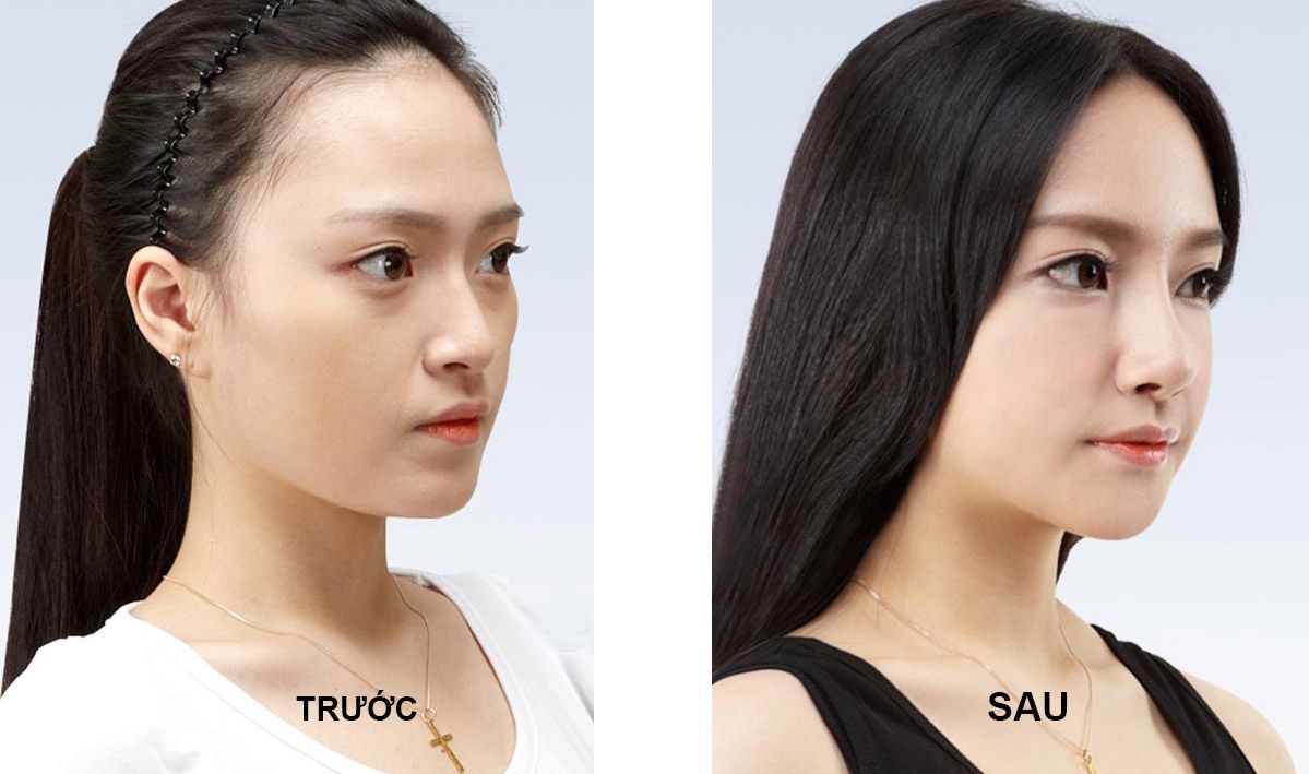 Nâng mũi bọc sụn tự thân giá bao nhiêu