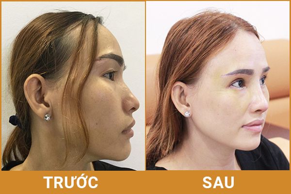 nâng mũi bọc sụn nhân tạo