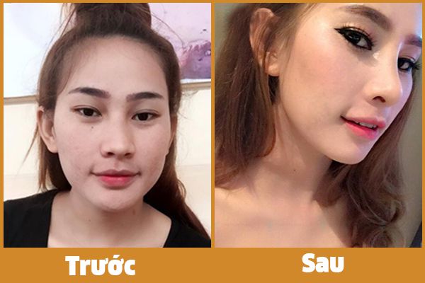 nâng mũi s line ở đâu