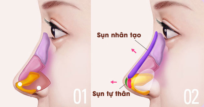 Nâng mũi bằng sụn tự thân ở đâu đẹp