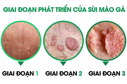 Chi phí đốt sùi mào gà bao nhiêu tiền 2019