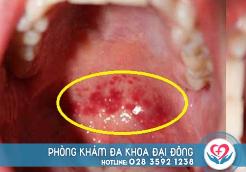 Viêm họng hạt là bệnh gì