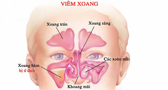 Nguyên nhân của viêm xoang hàm