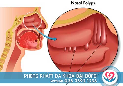 Polyp mũi có chữa được không