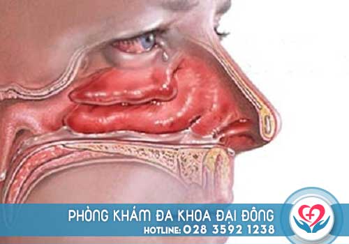 Polyp mũi là bệnh gì có nguy hiểm không\