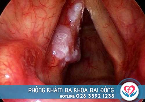 Polyp mũi chi phí chữa bao nhiêu