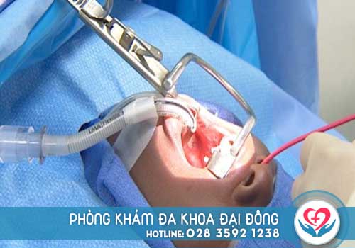 Chi phí cắt amidan bằng laser