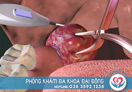 Chi phí cắt amidan bằng laser như thế nào