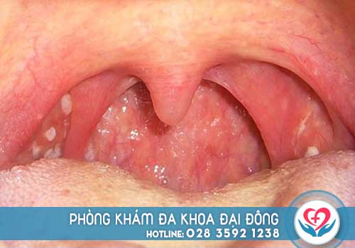 Viêm amidan hốc mủ