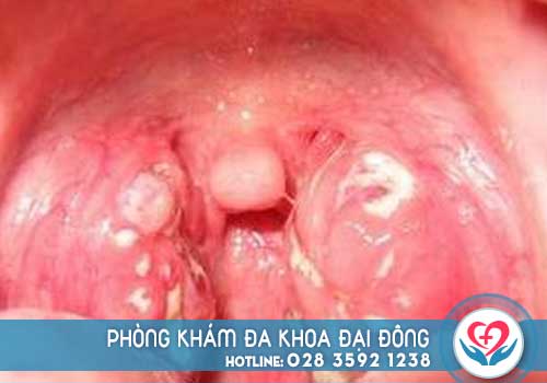 Viêm họng hạt mãn tính có nguy hiểm không