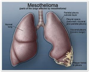 florida mesothelioma lawyer